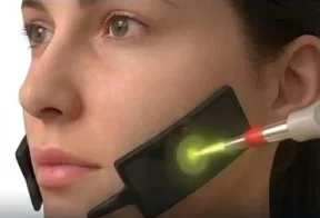 Carbon Shockwave Lifting: laser fired onto a carbon patch on the jawline